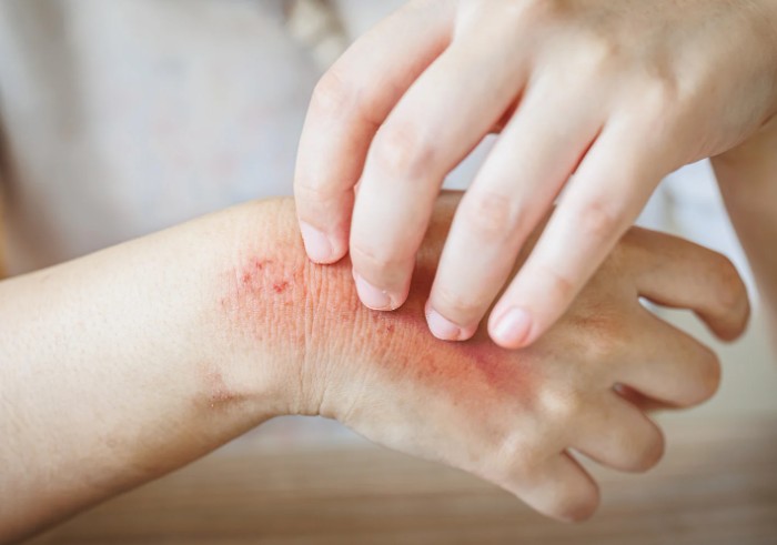 What Does a Carpet Beetle Rash Look Like